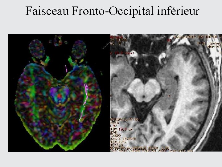 Faisceau Fronto-Occipital inférieur 