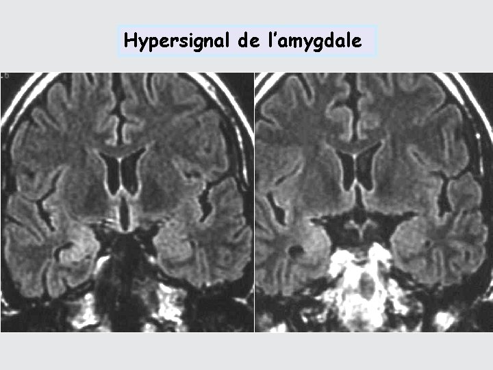 Hypersignal de l’amygdale 