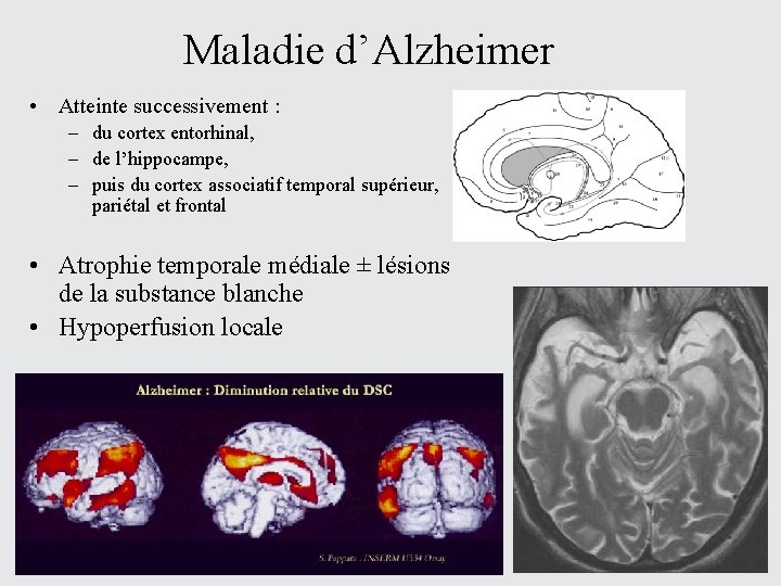 Maladie d’Alzheimer • Atteinte successivement : – du cortex entorhinal, – de l’hippocampe, –