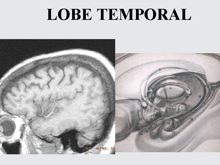 LOBE TEMPORAL 