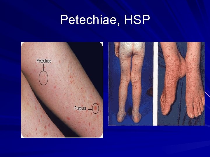 Petechiae, HSP 