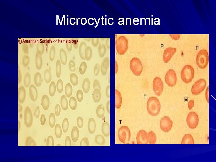 Microcytic anemia 