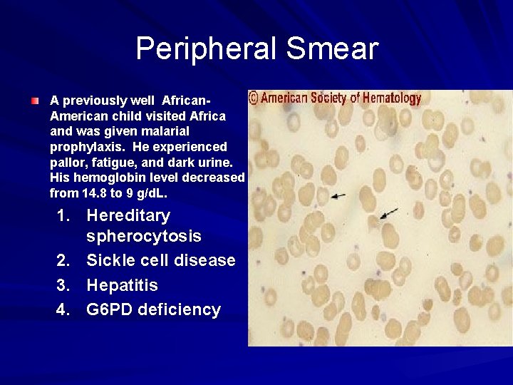 Peripheral Smear A previously well African. American child visited Africa and was given malarial