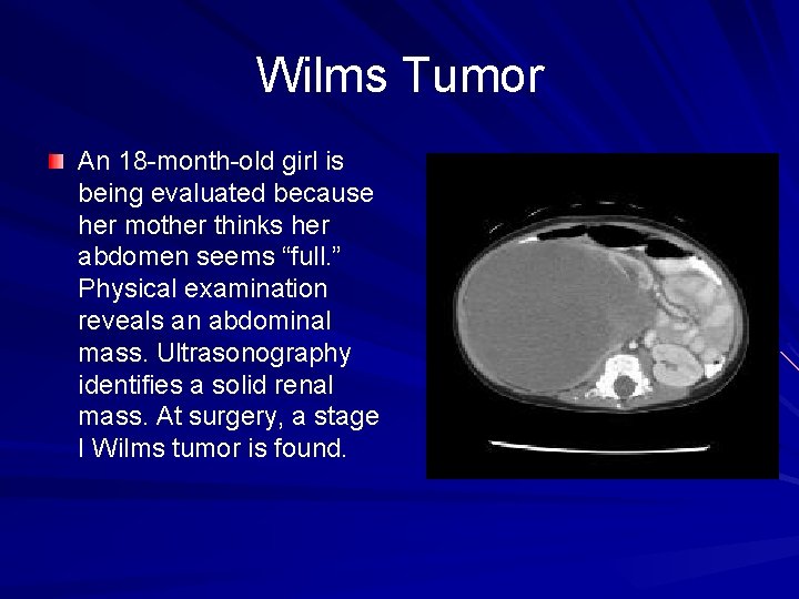 Wilms Tumor An 18 -month-old girl is being evaluated because her mother thinks her