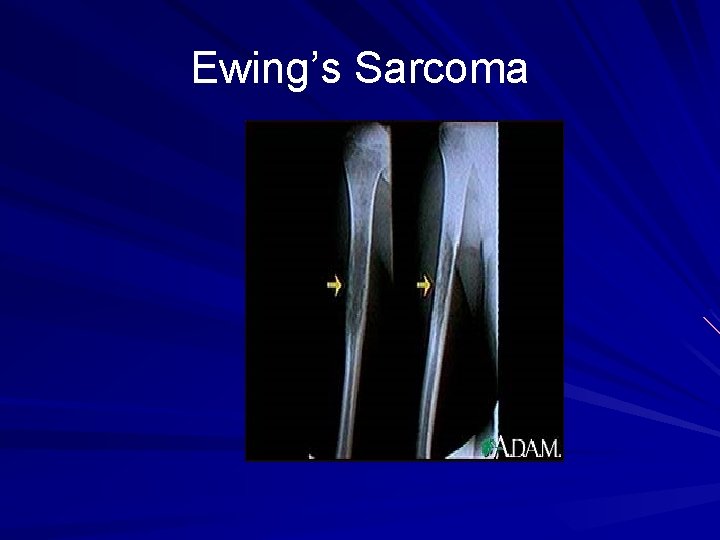 Ewing’s Sarcoma 