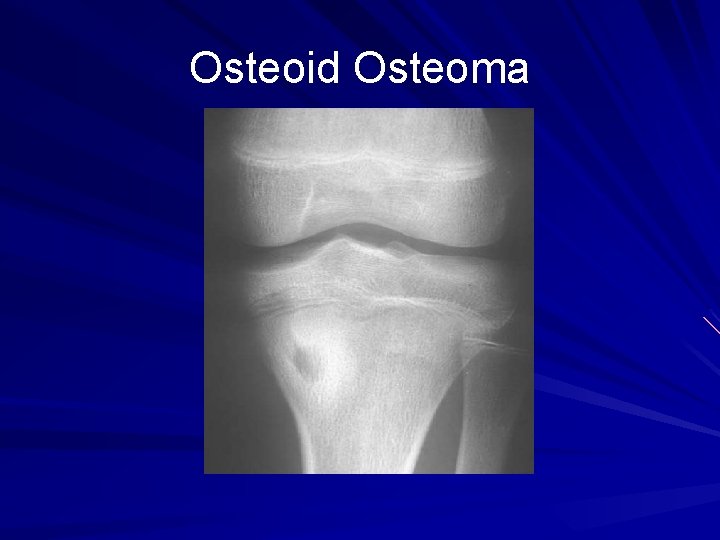 Osteoid Osteoma 