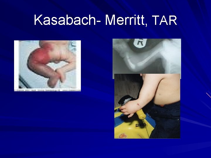 Kasabach- Merritt, TAR 