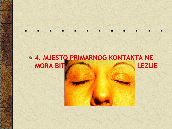 4. MJESTO PRIMARNOG KONTAKTA NE MORA BITI MJESTO MAKSIMALNE LEZIJE 