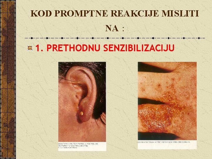 KOD PROMPTNE REAKCIJE MISLITI NA : 1. PRETHODNU SENZIBILIZACIJU 