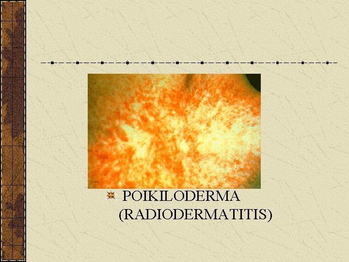  POIKILODERMA (RADIODERMATITIS) 