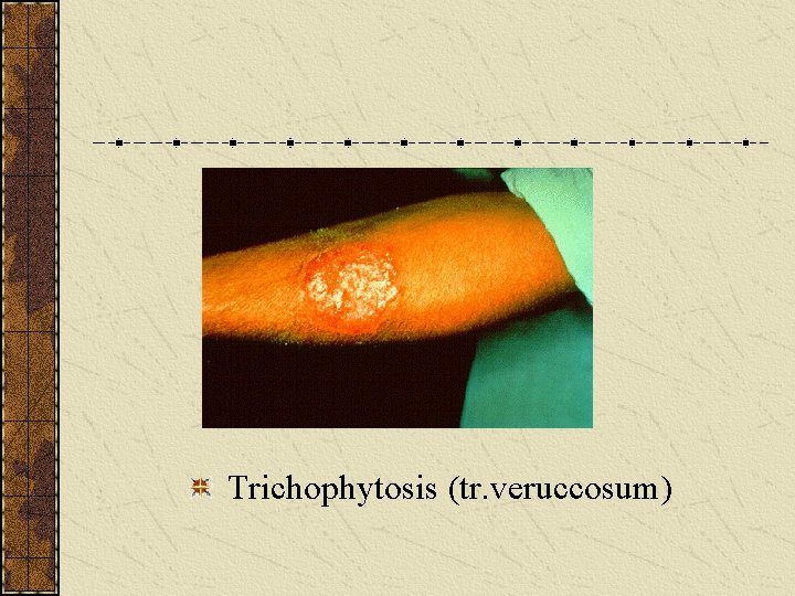  Trichophytosis (tr. veruccosum) 