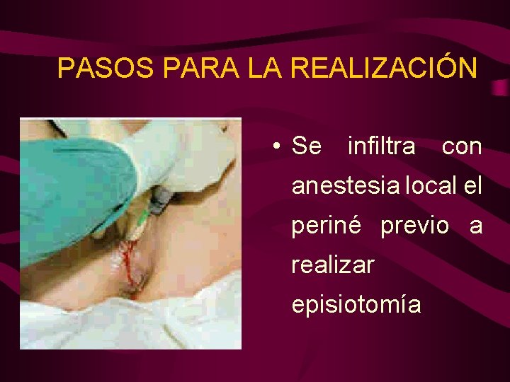 PASOS PARA LA REALIZACIÓN • Se infiltra con anestesia local el periné previo a