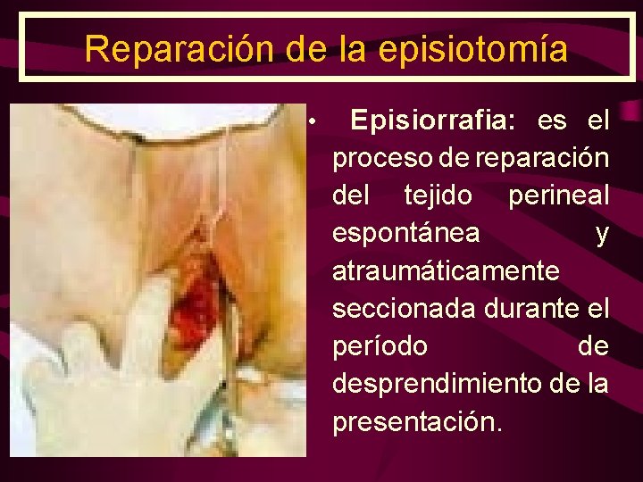 Reparación de la episiotomía • Episiorrafia: es el proceso de reparación del tejido perineal
