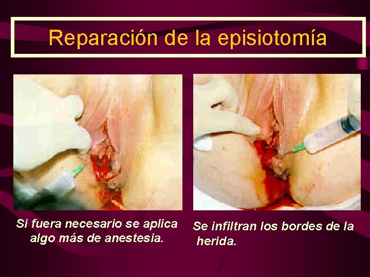 Reparación de la episiotomía Si fuera necesario se aplica algo más de anestesia. Se
