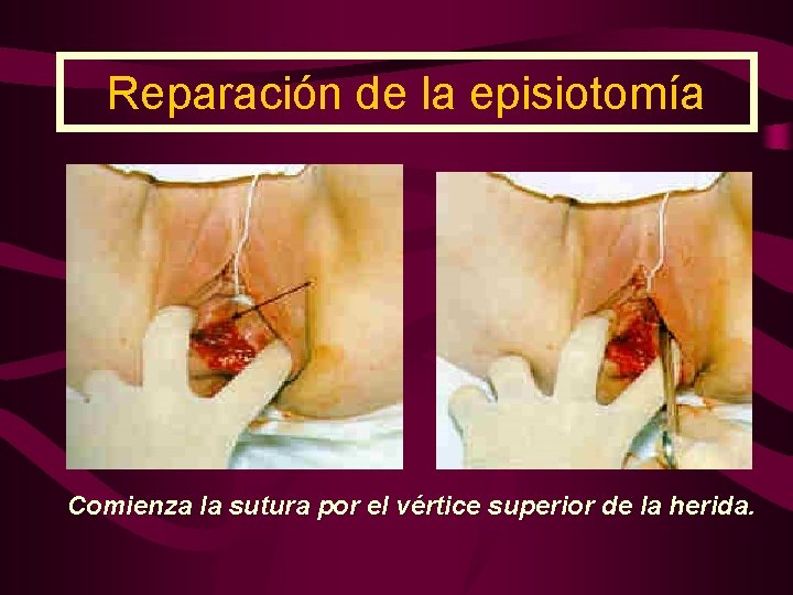 Reparación de la episiotomía Comienza la sutura por el vértice superior de la herida.
