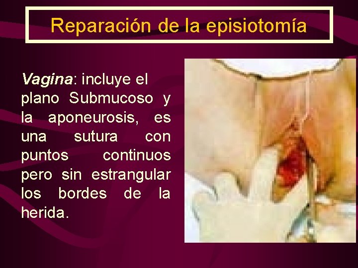 Reparación de la episiotomía Vagina: incluye el plano Submucoso y la aponeurosis, es una