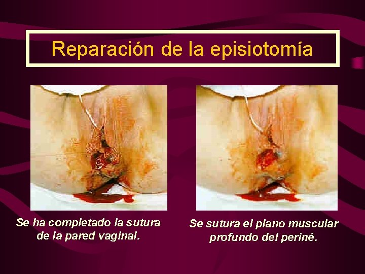 Reparación de la episiotomía Se ha completado la sutura de la pared vaginal. Se