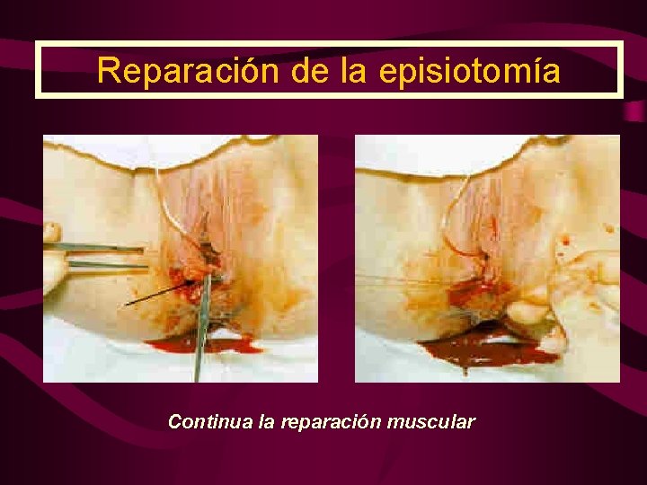 Reparación de la episiotomía Continua la reparación muscular 