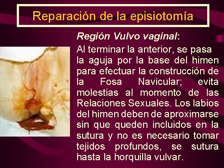 Reparación de la episiotomía Región Vulvo vaginal: Al terminar la anterior, se pasa la