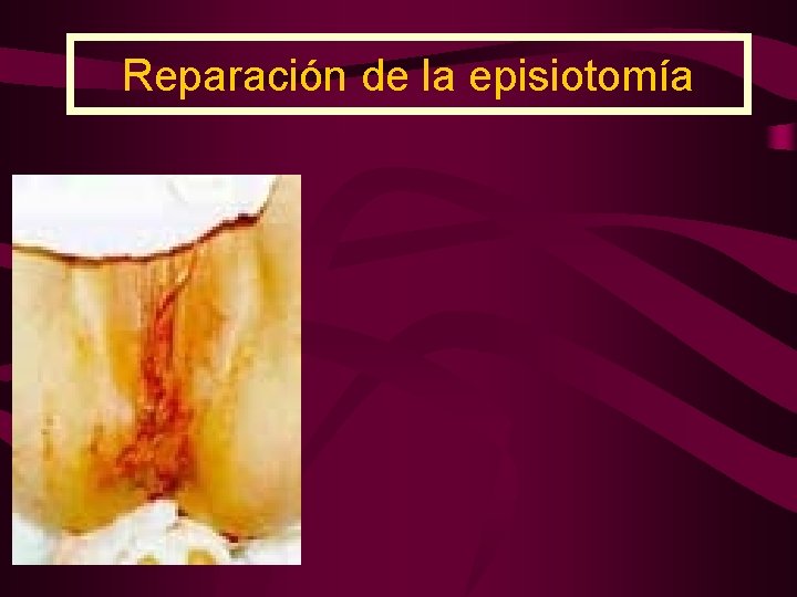 Reparación de la episiotomía 