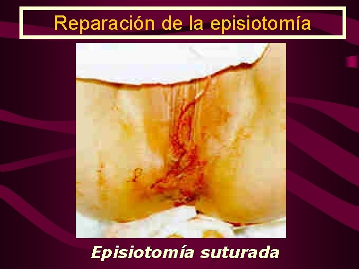 Reparación de la episiotomía Episiotomía suturada 