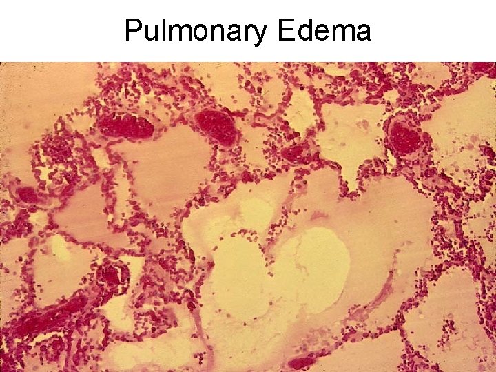 Pulmonary Edema 