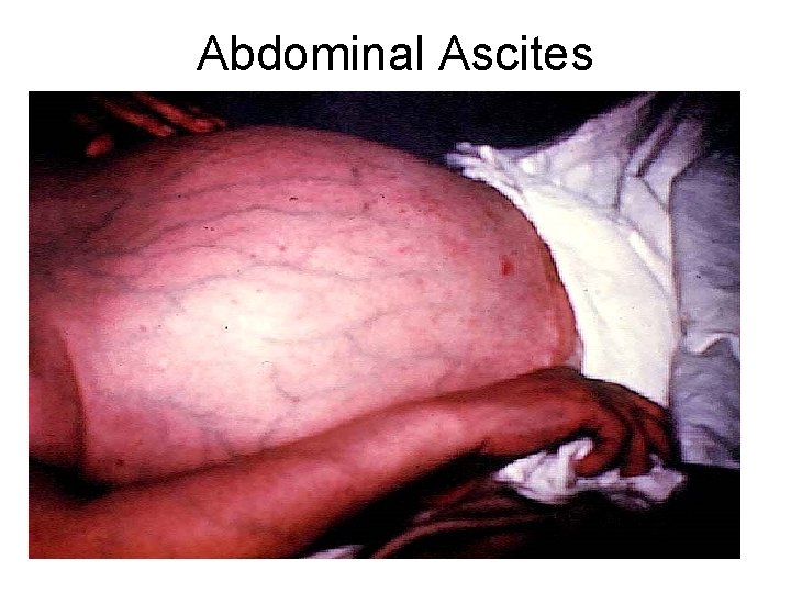 Abdominal Ascites 