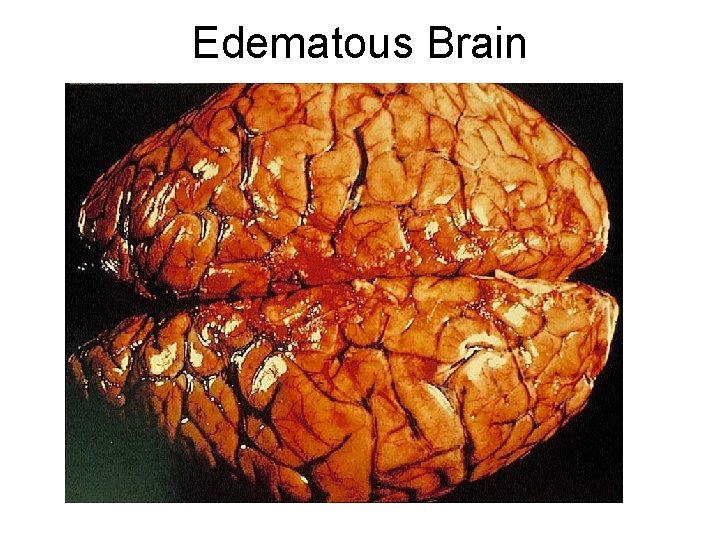 Edematous Brain 