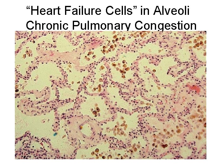 “Heart Failure Cells” in Alveoli Chronic Pulmonary Congestion 