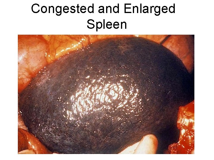Congested and Enlarged Spleen 