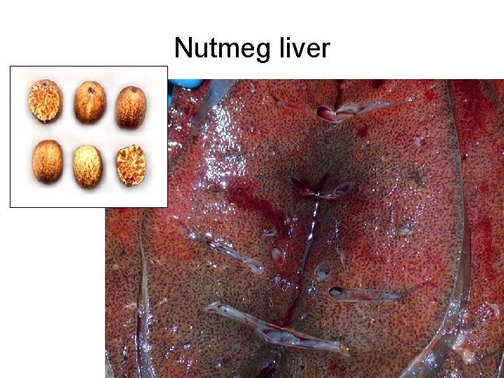 Nutmeg liver 