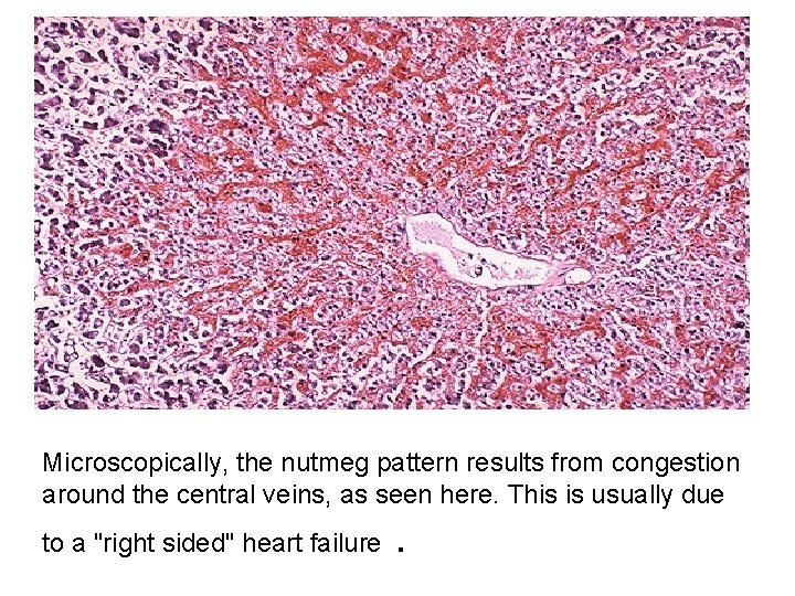 Microscopically, the nutmeg pattern results from congestion around the central veins, as seen here.