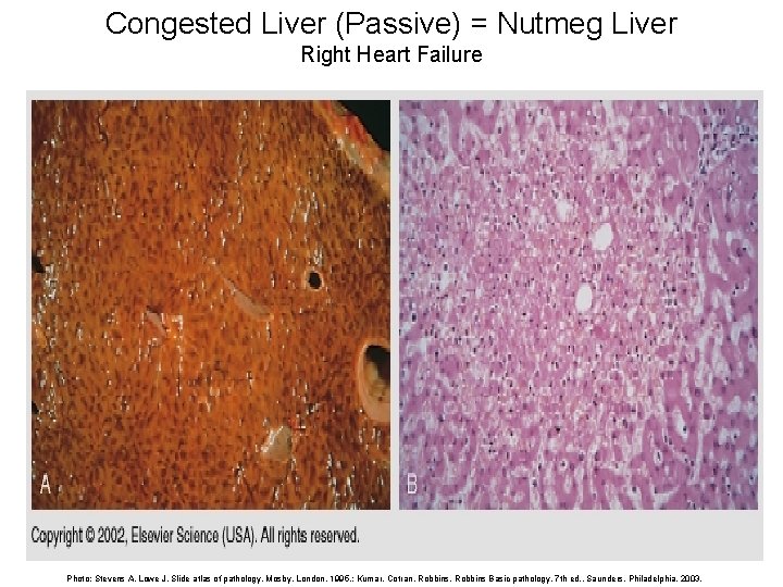 Congested Liver (Passive) = Nutmeg Liver Right Heart Failure Photo: Stevens A, Lowe J.