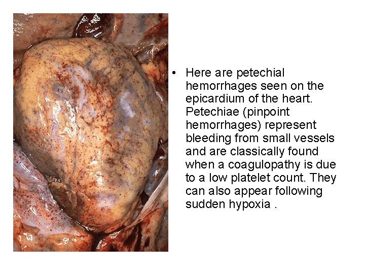  • Here are petechial hemorrhages seen on the epicardium of the heart. Petechiae