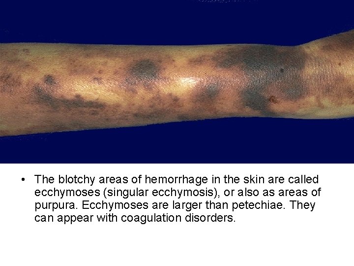  • The blotchy areas of hemorrhage in the skin are called ecchymoses (singular