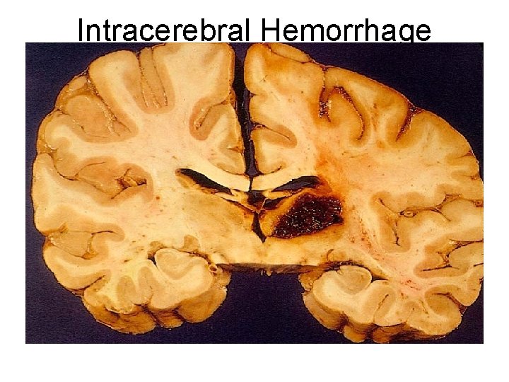 Intracerebral Hemorrhage 