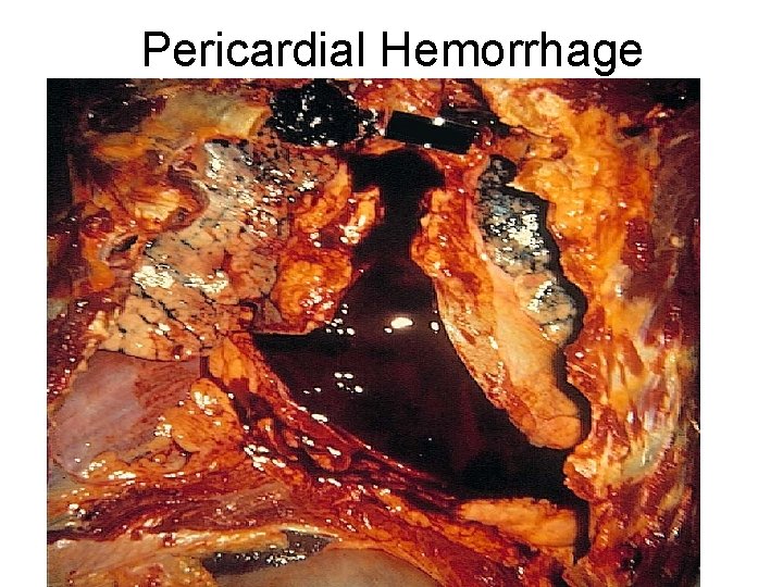 Pericardial Hemorrhage 