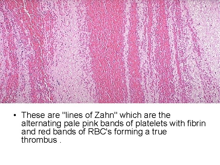  • These are "lines of Zahn" which are the alternating pale pink bands