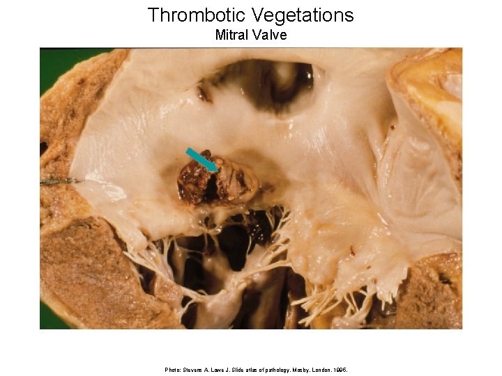 Thrombotic Vegetations Mitral Valve Photo: Stevens A, Lowe J. Slide atlas of pathology. Mosby,