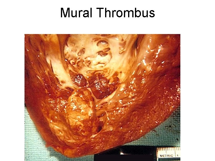 Mural Thrombus 