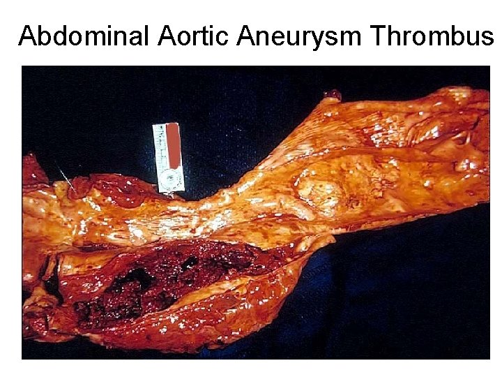 Abdominal Aortic Aneurysm Thrombus 