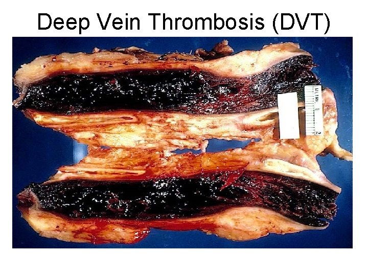 Deep Vein Thrombosis (DVT) 