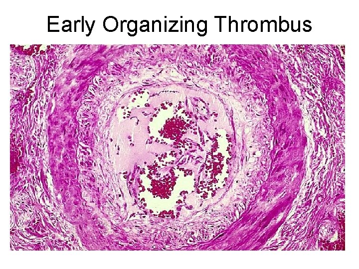 Early Organizing Thrombus 