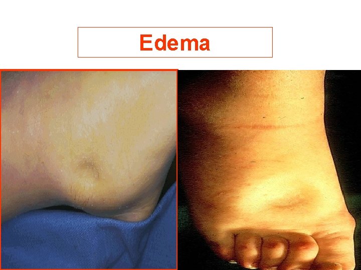 Edema 