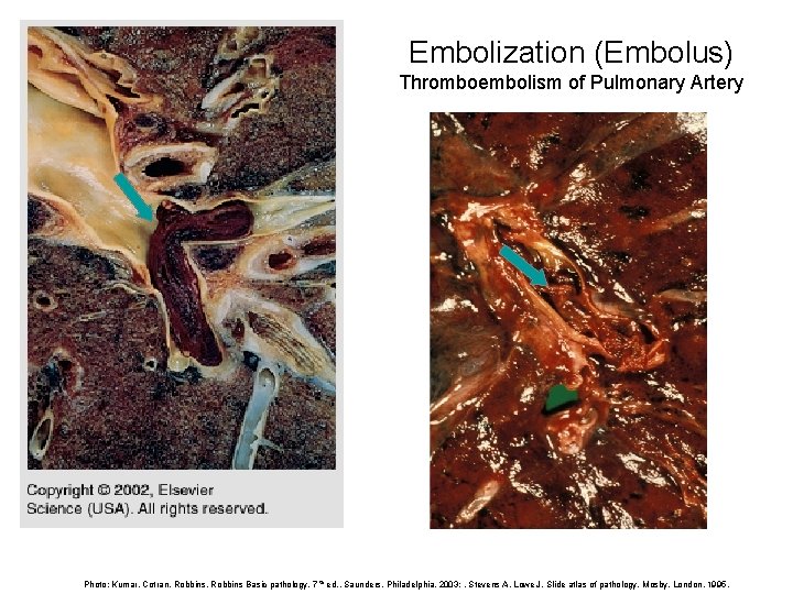 Embolization (Embolus) Thromboembolism of Pulmonary Artery Photo: Kumar, Cotran, Robbins Basic pathology, 7 th