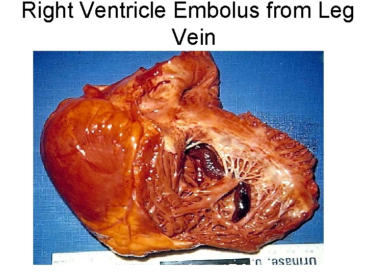 Right Ventricle Embolus from Leg Vein 