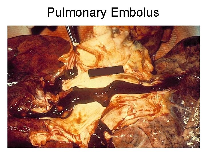 Pulmonary Embolus 