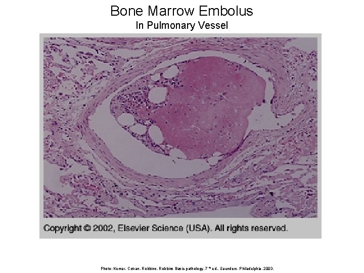 Bone Marrow Embolus In Pulmonary Vessel Photo: Kumar, Cotran, Robbins Basic pathology, 7 th