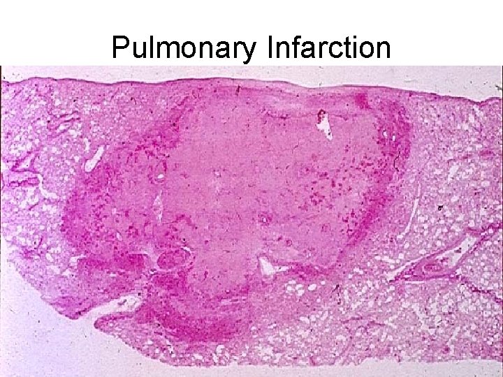 Pulmonary Infarction 