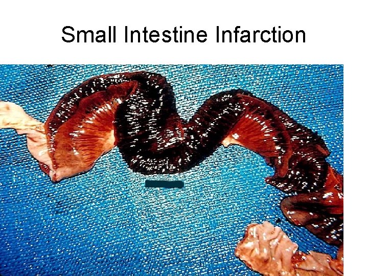 Small Intestine Infarction 